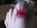 My Toe After Dropping a Cintiq Stand on it